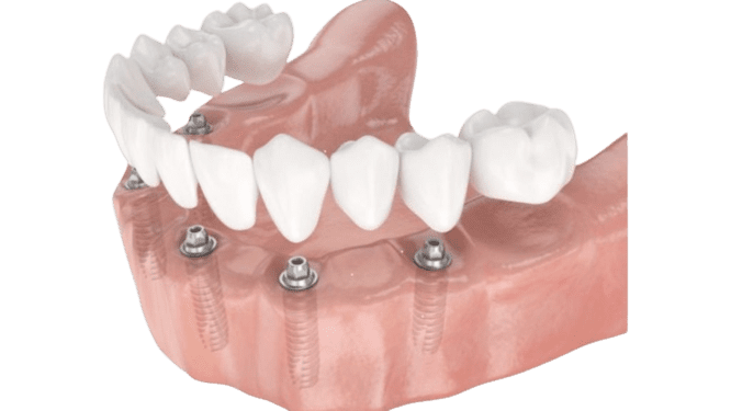 implant dentaire chambery